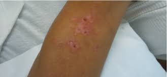 Use gloves and long sleeves when handling wires, rose bushes, hay bales, pine. Sporotrichosis Diagnosis And Management Consultant360