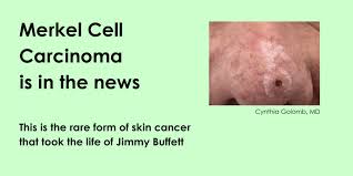 Image result for Merkel Cell Carcinoma