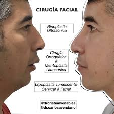 perfiloplastía #claseiiesqueletal