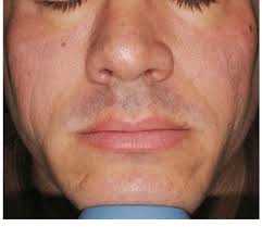 The hollowed cheeks can be filled successfully with ArteFill through a...