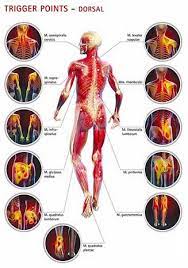 Myofascial Pain Syndrome Muscle Ache Complete Spine And Pain Care