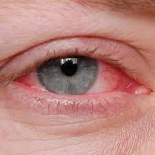 Image result for Gonococcal Conjunctivitis