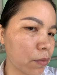 What are some treatments for freckles and uneven skin tone?