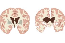 View common signs and symptoms of hd chorea and learn about a treatment option. Chorea Huntington Ursachen Symptome Und Therapie Emedi De