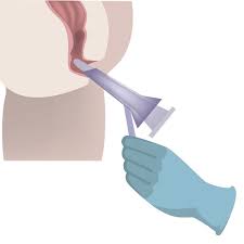 Image result for Anoscopy