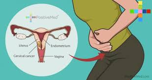 Watery, bloody vaginal discharge that may be heavy and have a foul odor. Cervical Cancer Signs Of Cervical Cancer Kimaja Farwani