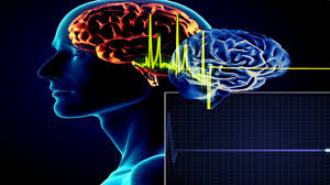 Thrombosis of cerebral veins and venous sinuses is a rare disease, which accounts for less than 1 the most frequent and often early symptom of thrombosis of cerebral veins and sinuses is a headache. Que Es La Muerte Cerebral Y Cuando Se Diagnostica Infobae