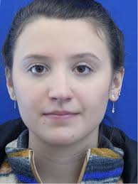 Deviated Middle Vault 5493