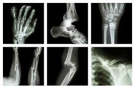 Image result for Fracture