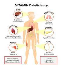Pin By Idris Sardi On Tahanklik Blogspot Com Vitamin D Deficiency Vitamin Deficiency Vitamin D Deficiency Symptoms