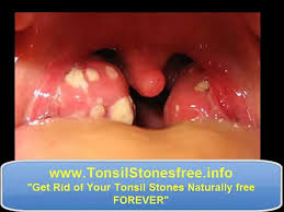 How do i stop getting tonsil stones? Waterpik Tonsil Stones How To Remove Tonsil Stones Video Dailymotion