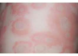 Often overlooked, the most important step in the fungal infection treatment is to identify what is the cause of fungal infection on skin, as the needed treatment may be completely different. Most Effective Natural Remedies For Nail Fungus Reenu S Zone Treat Skin Nail Fungus Remedy Skin Infection