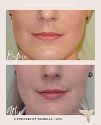 How much juvederm for lips. Lip Filler Vs Lip Lift Vs Lip Flip Skin By Lovely