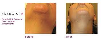 Laser hair removal pros, cons, types, and cost. Hair And Skin Removal System Energist Vpl