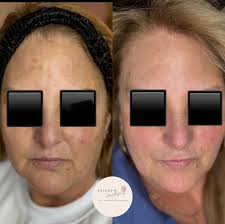 Melasma? We don't know her Sun Damage and uneven pigmentation? Let's fix  that! ••••• Did you know there are different factors that can cause  hyperpigmentation and melasma issues? The most common types