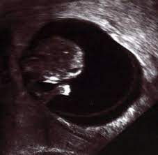 In diesem fall sollte man unbedingt mit. Fehlgeburten Jede Dritte Schwangerschaft Endet Mit Dem Abort Welt