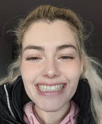 So I haven't decided wether to go for clear correct yet but looking at the  before & after it's the gaps beside my two front teeth at the end that's  putting me