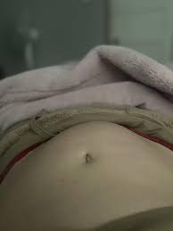 Can anyone actually see their large fibroid when you lay down?? : rFibroids