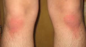 Awesome How Long Does Rug Burn Last In 2020 Burns Rugs Pics