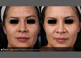 Stretch Mark And Scar Reduction Specialists