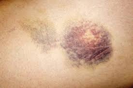 Fair skinned older people are more likely to develop. Causes Of Purpura Purple Spots On Skin