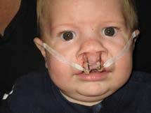 The University of New Mexico Cleft and Craniofacial Clinic