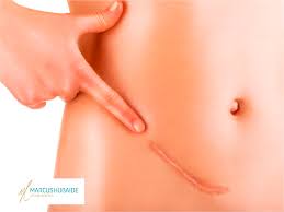 Saiba Tudo Sobre Seroma Dr Marcus Hubaide Cirurgia Plastica