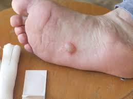 Image result for pompholyx soles of feet