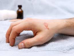 Maybe you would like to learn more about one of these? Effective Home Remedies To Soothe Burns The Times Of India