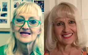 Free Dental Program for Veterans