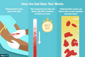 If you're getting a few blood tests, more than one test tube may be attached to the needle before it's withdrawn. Erythrocyte Sedimentation Rate Uses Procedure Results