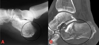 Image result for Calcaneus Compression Fracture