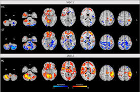 Последние твиты от voxel.rl (@rlvoxel). Voxel Based Morphometry And Task Functional Magnetic Resonance Imaging In Essential Tremor Evidence For A Disrupted Brain Network Scientific Reports