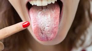 Image result for brown tongue symptoms