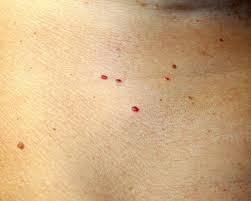 7 Reasons Your Skin Has Red Spots And Bumps In 2020 Red Skin Spots Red Spots On Face Skin Spots