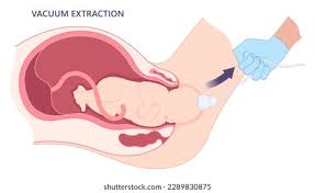 Image result for Forceps Assisted Delivery