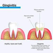 Image result for Gingivitis