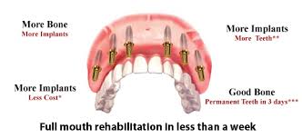 Full Mouth Dental Implants In India Fms Dental Hospital Hyderabad