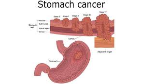 Gastric cancer (gc) remains the leading cause of cancer mortality worldwide. Stomach Cancer Symptoms What Colour Are Your Stools Sign Of Disease To Watch Out For Express Co Uk