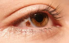 Image result for nevus sclerae