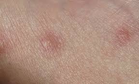 La gran parte dei soggetti guarisce spontaneamente, senza trattamento. Orticaria Psicosomatica Da Stress Dott Ssa Serenella Salomoni
