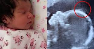 With that being said, if you haven't had previous complications in pregnancy and you're relatively healthy, it's better to wait until. Doctors Give Mom 4 Word Prediction At Ultrasound Baby Stuns All At Birth