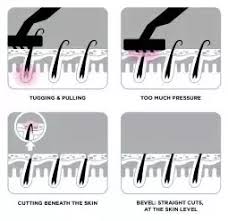 Razor bumps are basically ingrown hairs, which can pop up anywhere you remove hair, and often occur on more delicate areas where the hair is coarse, like the bikini line. After A Shave Where Do You Get Razor Bumps Or Ingrown Hairs Quora