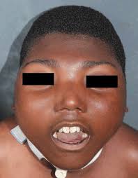 Approach to Autopsy of the Perinatal Nervous System