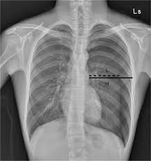 This is the one not to miss. Pneumothorax Concise Medical Knowledge