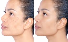 Image result for Melasma