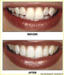 Zirconiium Esthetic Crowns Cad Cam Aesthetic Dentistry Pinterest Cad Cam And Crowns