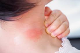 Only a few spiders produce significant poison most bites are from female spiders little, immediate pain; 17 Signs Your Bug Bite Is Something Serious Best Life