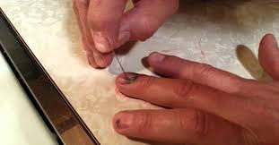 Slijedite ove savjete za zacjeljivanje modrica. Modrice Ispod Noktiju Uzroka Podnogo Hematoma Ozljeda Noktiju Dijagnoza I Lijecenje Modrice Ispod Nokta Palca