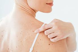 Opasnye Rodinki Kak Uberechsya Ot Melanomy Gromadskoe Televidenie Gromadskoe Televidenie